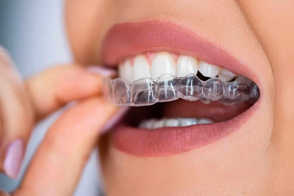 Элайнеры для зубов: выравнивание с умом и по доступной цене