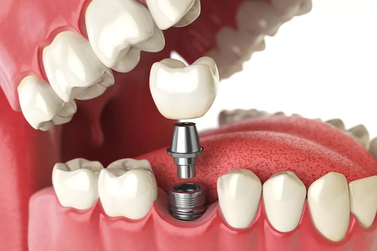 Осложнения при имплантации зубов какие бывают и как их избежать?