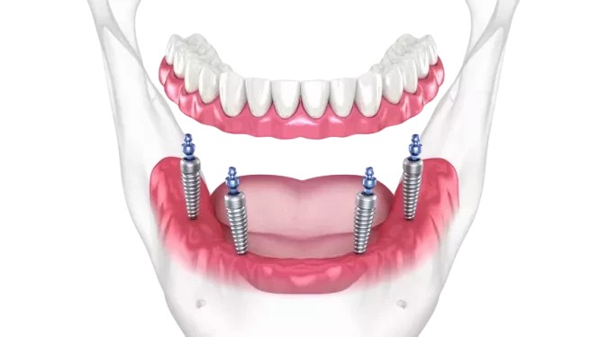 Имплантация по методике All-on-4