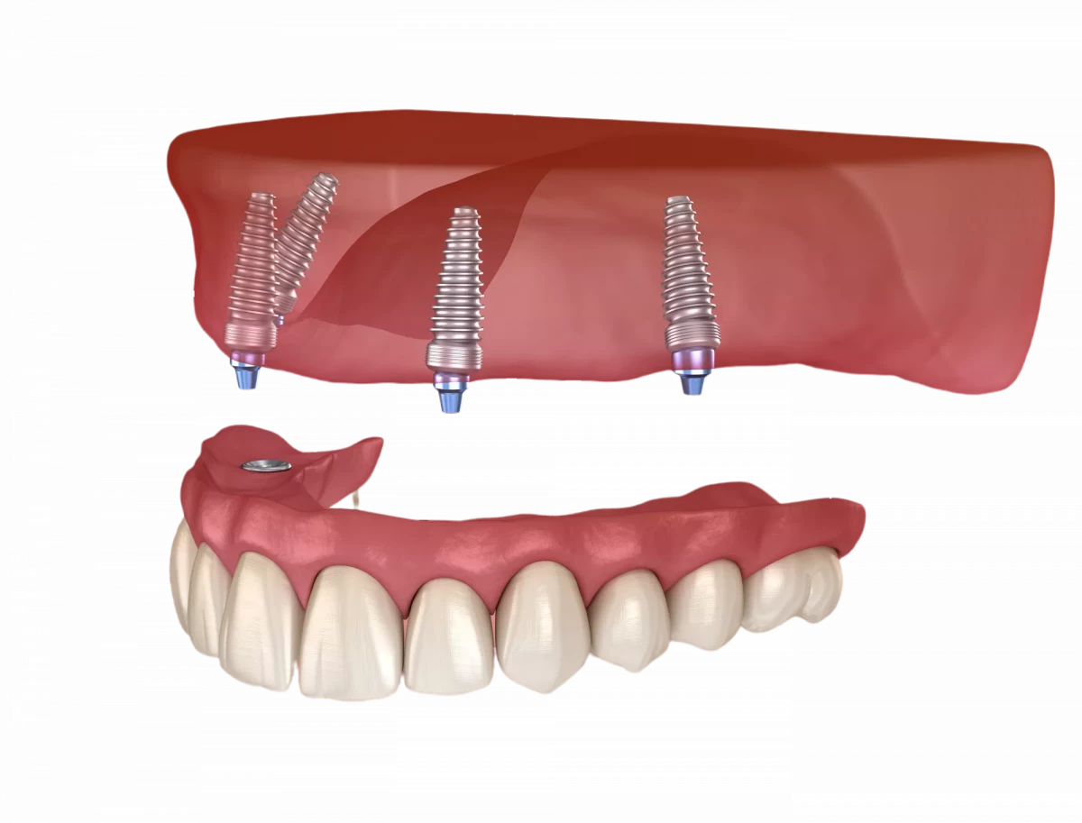 Имплантация зубов по методу All-on-6