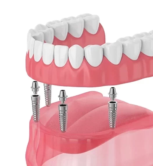 Новые зубы за 1 день по технологии ALL-ON-4 на имплантатах в Белгороде
